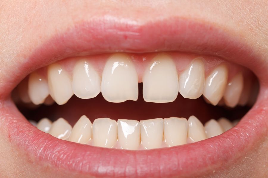 Tratamiento para solucionar los dientes separados (diastema)
