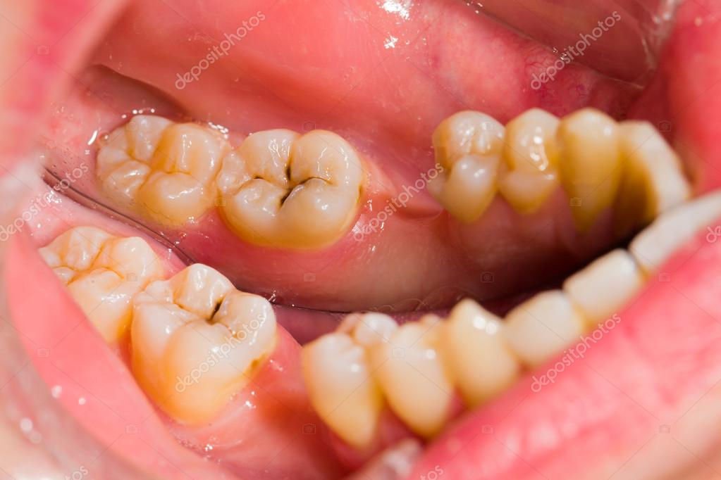 caries diente
