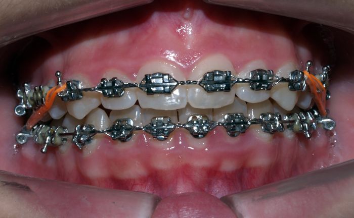 Por qué las gomas en ortodoncia? - Dental