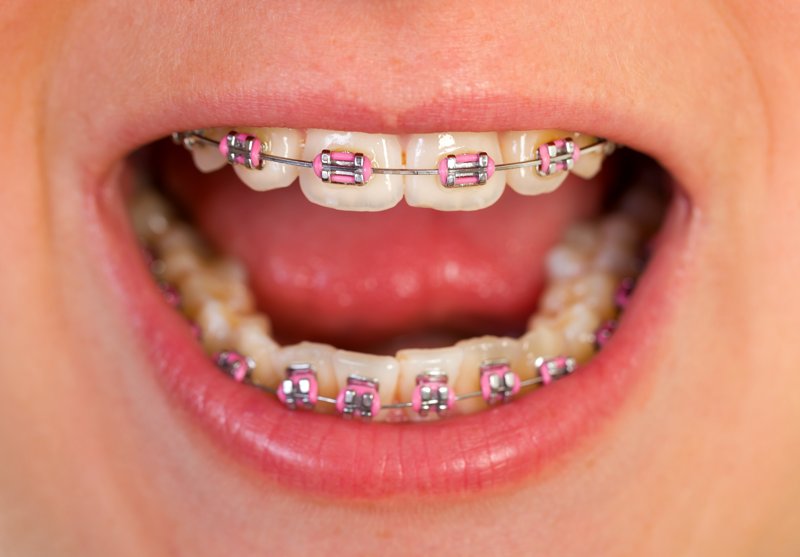 Por qué las gomas en ortodoncia? - Dental