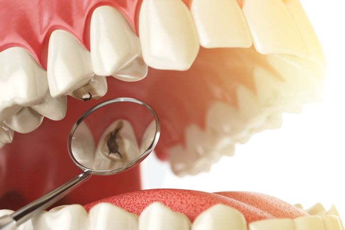 ¿En qué consiste una obturación dental?