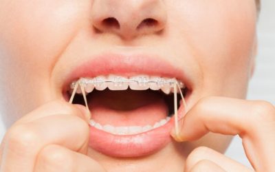 ¿Por qué se utilizan las gomas en ortodoncia?