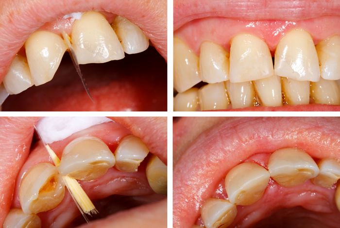 Tipos de obturaciones dentales