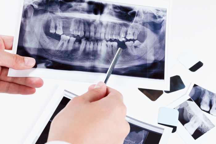 Para realizar un injerto óseo dental es fundamental
