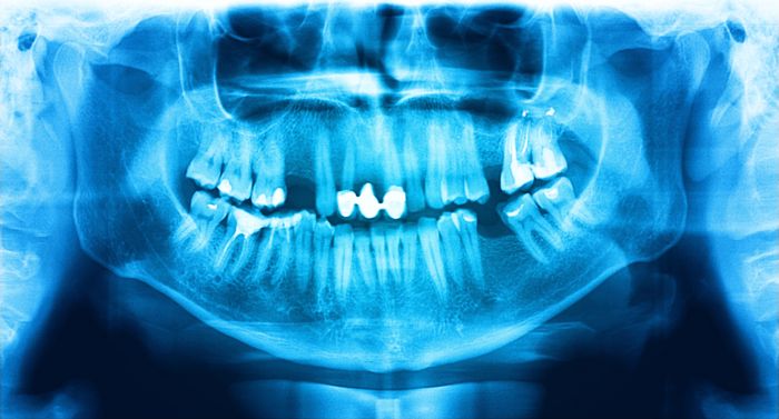 causas perdida hueso dental Axioma clínica dental en Barcelona