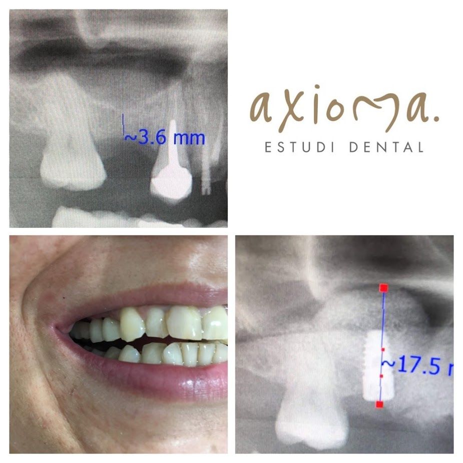 injerto oseo axioma estudi dental Axioma clínica dental en Barcelona