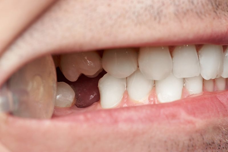 Los peligros de la falta de hueso dental
