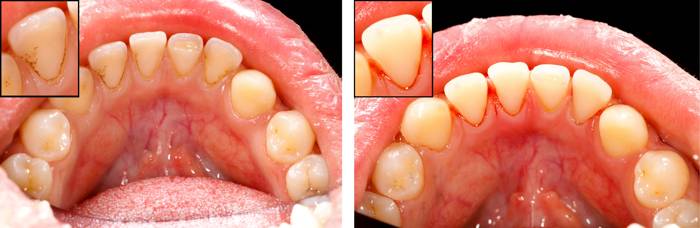 Causas y prevención de la periodontitis