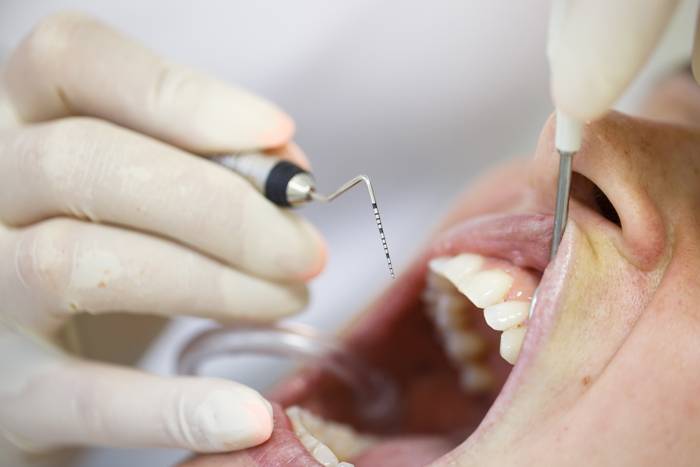 Procediment d'un tractament de periodoncia