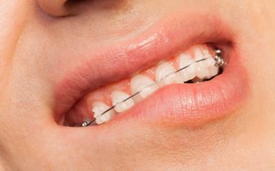 Cera de ortodoncia: Usos y ventajas