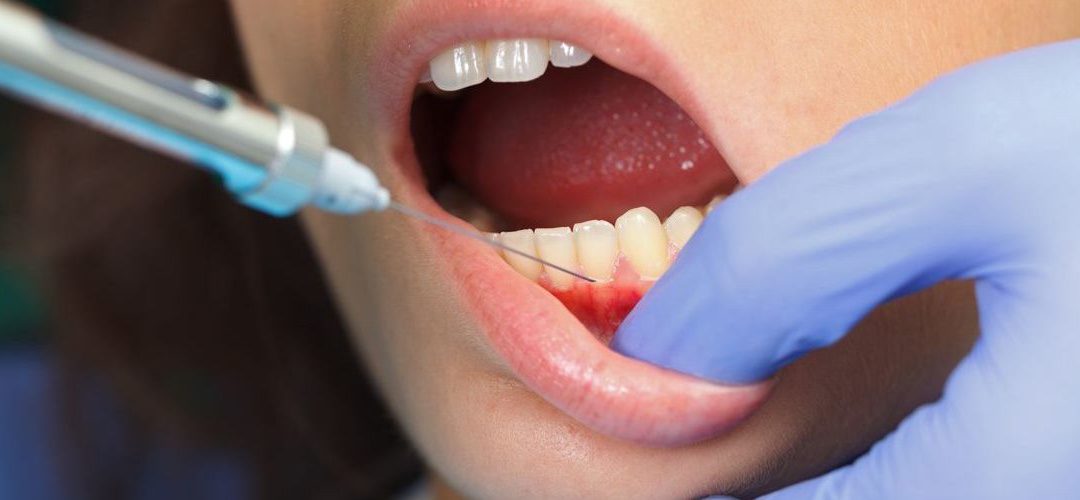 ¿Cuánto dura la anestesia dental?