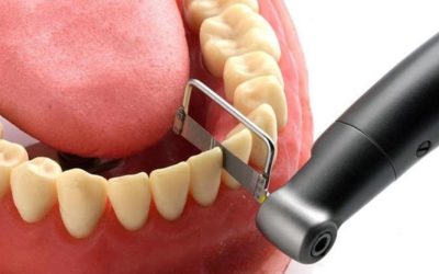 ¿Qué es el stripping dental en ortodoncia?