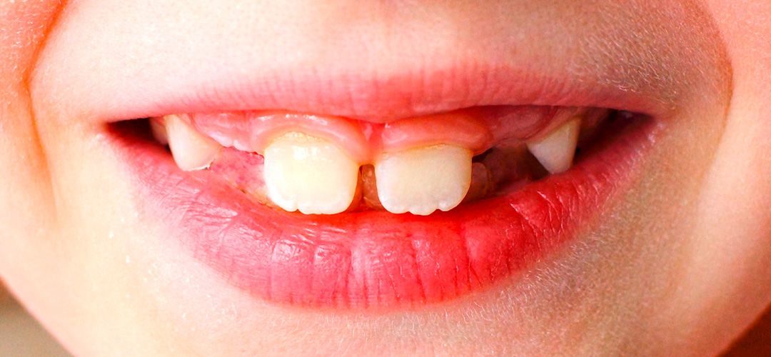 Qué es agenesia dental y cómo tratarla